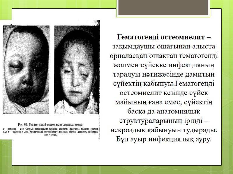 Гематогенді остеомиелит – зақымдаушы ошағынан алыста орналасқан ошақтан гематогенді жолмен сүйекке инфекцияның таралуы нәтижесінде